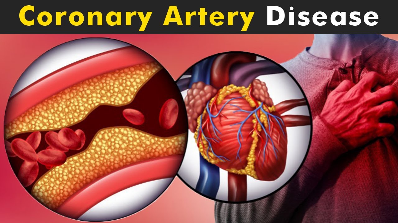 Coronary artery disease evaluation